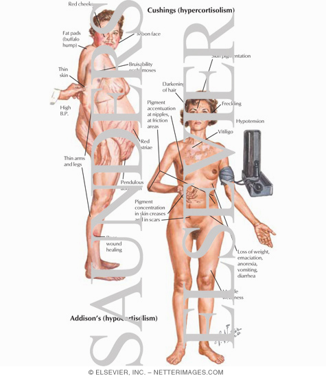 Watermarked preview of labeled image: Cushing's (Hypercortisolism)