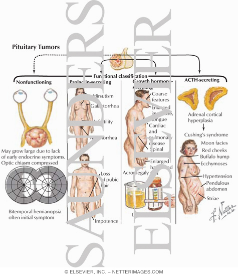 Watermarked preview of labeled image: Pituitary Disorders