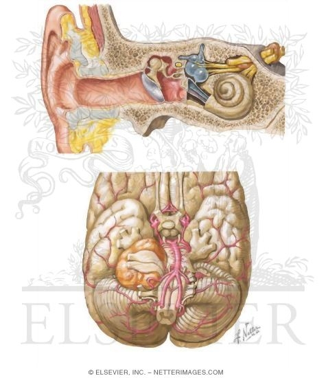 Acoustic Neuroma