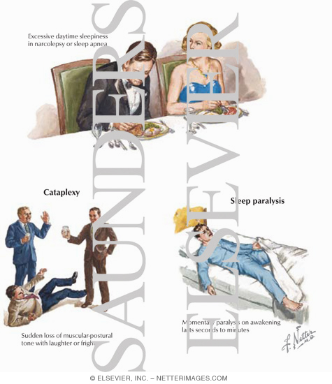 Narcolepsy