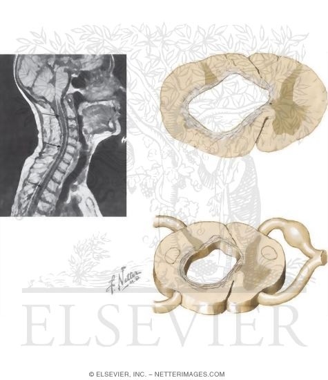 Watermarked preview of unlabeled image: Syringomyelia