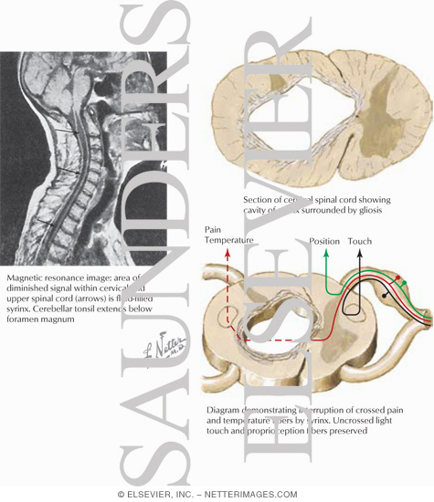 Watermarked preview of labeled image: Syringomyelia