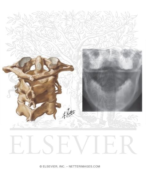 Cervical Vertebrae: Atlas and Axis