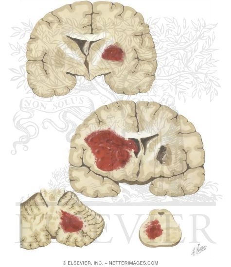 Watermarked preview of unlabeled image: Hypertensive Apoplexy