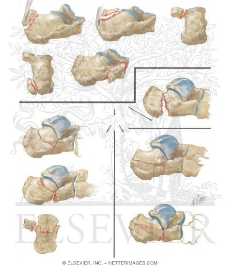 Watermarked preview of unlabeled image: Fractures of the Calcaneus