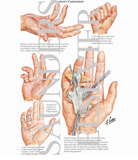 Watermarked preview of labeled image: Dupuytren's Contracture