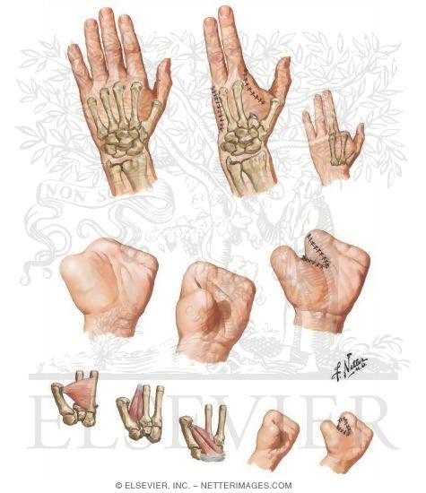 Amputation of Finger and Ray