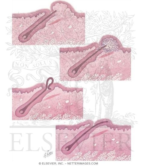 Watermarked preview of unlabeled image: Shaving: A Cause of Skin Disorders