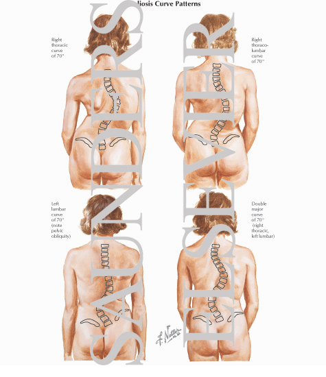 Scoliosis Curve Patterns