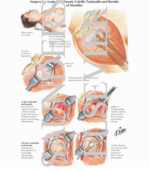 Watermarked preview of labeled image: Surgery for Acute and Chronic Calcific Tendonitis and Bursitis of Shoulder