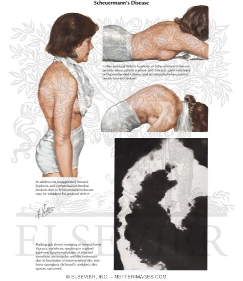 Scheuermann's Disease