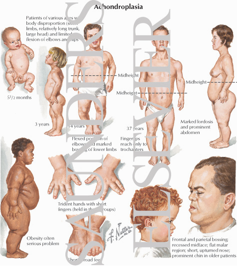 Achondroplasia