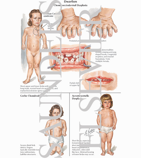 Watermarked preview of labeled image: Chondroectodermal Dysplasia