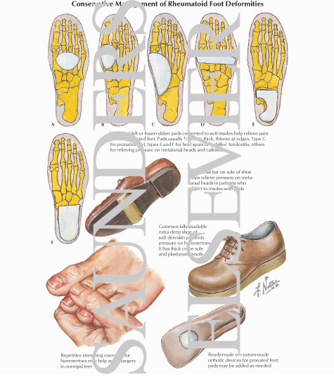 Watermarked preview of labeled image: Conservative Management of Rheumatoid Foot Deformities