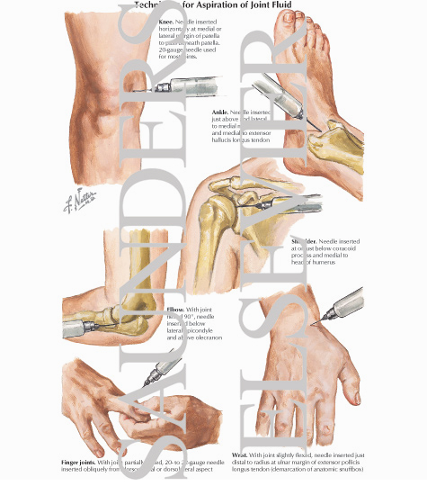 Watermarked preview of labeled image: Techniques for Aspiration of Joint Fluid