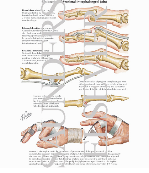 Dorsal and Palmar Interphalangeal Joint Dislocations