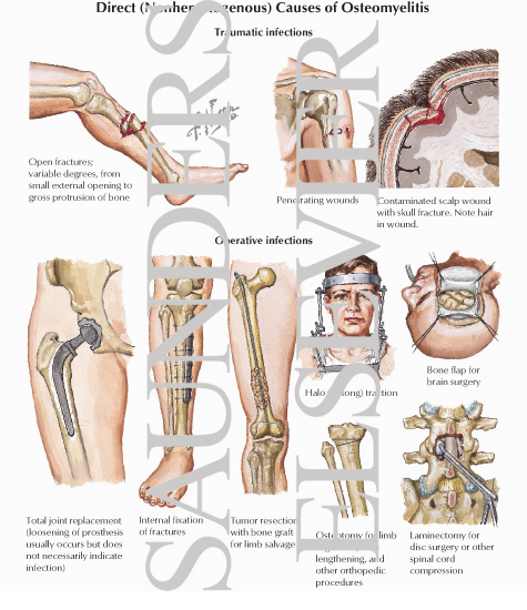Watermarked preview of labeled image: Direct (Nonhematogenous) Causes of Osteomyelitis
