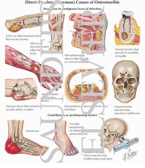 Direct (Nonhematogenous) Causes of Osteomyelitis