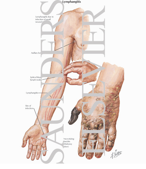 Lymphangitis