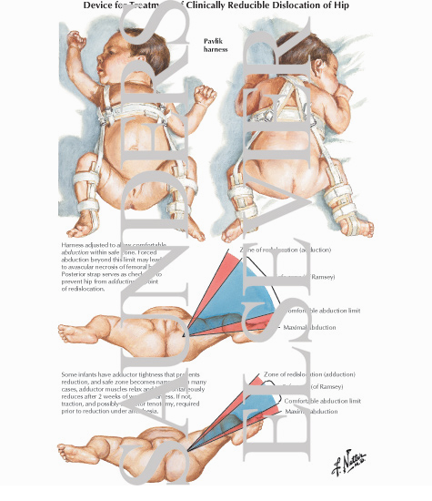 Watermarked preview of labeled image: Device for Treatment of Clinically Reducible Hip Dislocation