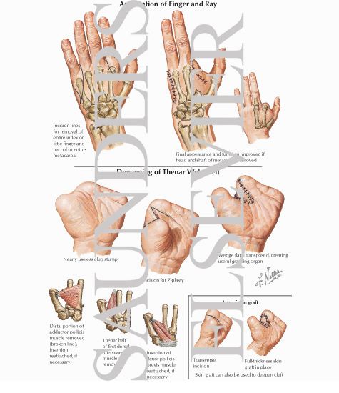 Amputation of Finger and Ray