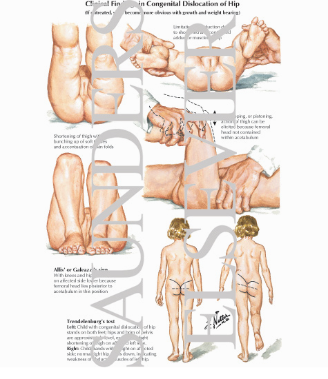 Clinical Findings in CDH