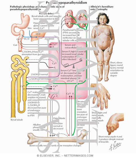 Pathologic Physiology And Characteristic Signs Of Pseudohypoparathyroidism