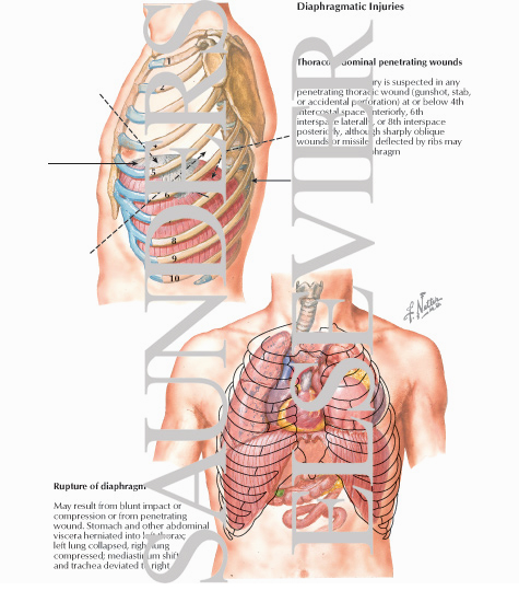 Diaphragmatic Injuries