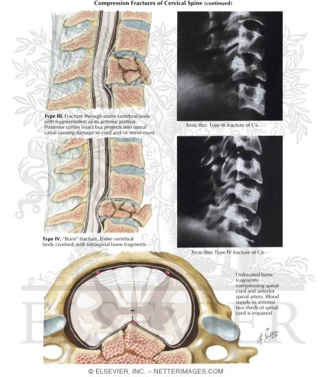 Watermarked preview of labeled image: Compression Fractures of Cervical Spine