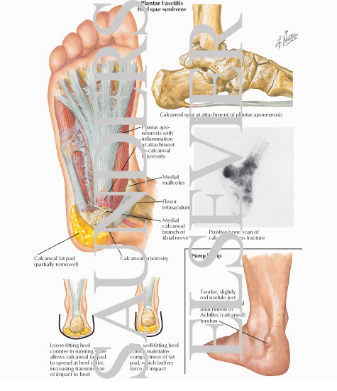 Plantar Fasciitis
