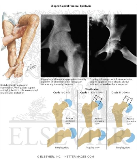 Slipped Capital Femoral Epiphysis