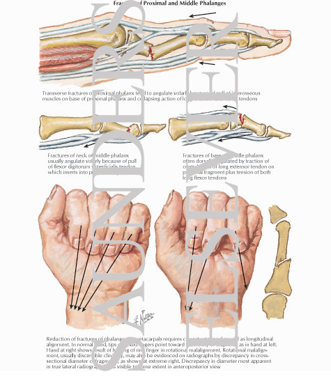 Fracture of Proximal and Middle Phalanges