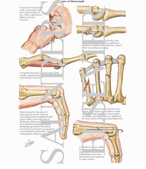 Fracture of Metacarpals