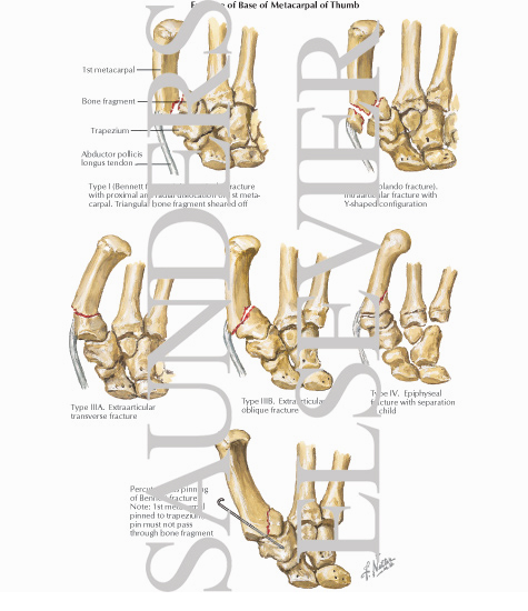 Fracture of Base of Metacarpal of Thumb