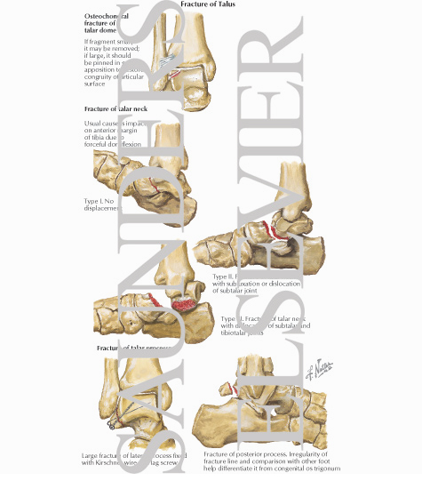 Fracture of Talus
Fracture of Talar Neck