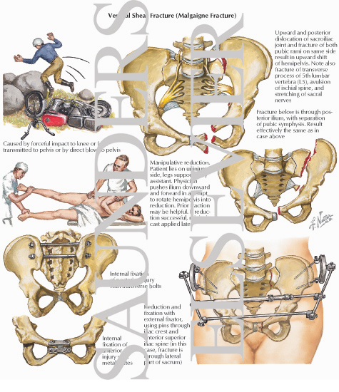 Vertical Shear Fracture (Malgaigne Fracture)