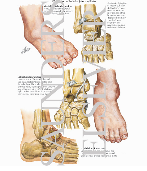 Dislocation of Subtalar Joint and Talus