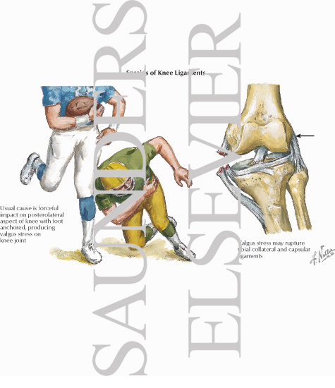 Watermarked preview of labeled image: Sprains of Knee Ligaments
