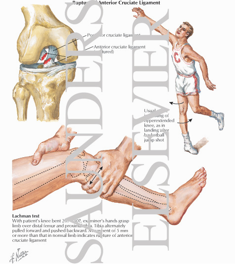 Watermarked preview of labeled image: Rupture of Anterior Cruciate Ligament