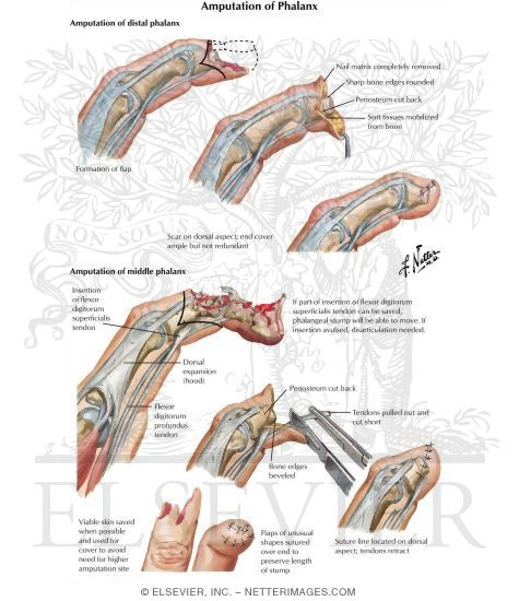 Amputation of Phalanx