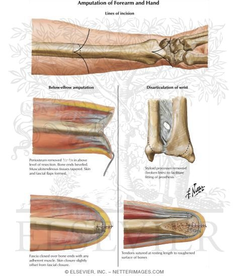 Amputation of the Forearm - Disarticulation Through the Wrist