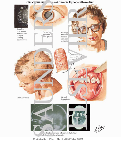 Clinical Manifestations of Chronic Hypoparathyroidism