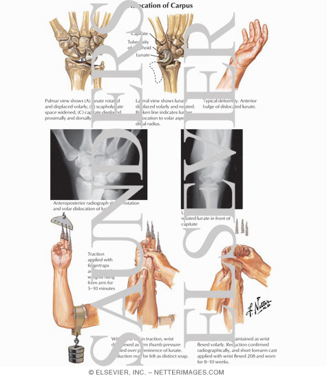 Watermarked preview of labeled image: Dislocation of the Lunate