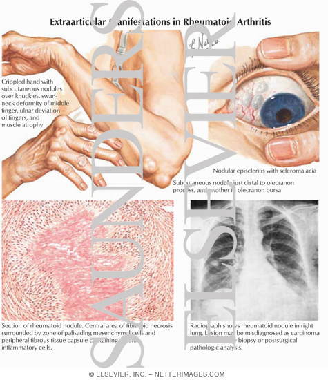 Subcutaneous Nodules