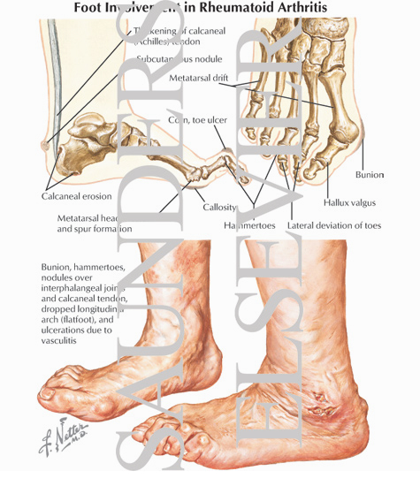 The Feet In Rheumatoid Arthritis