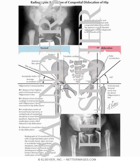 Watermarked preview of labeled image: Radiologic Diagnosis of CDH