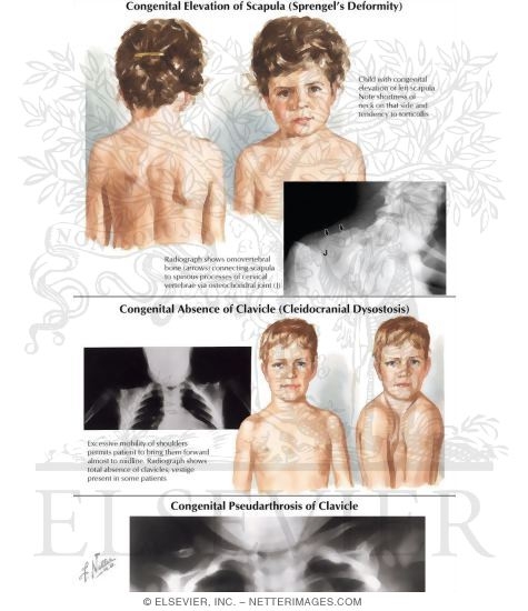 Congenital Elevation of Scapula (Sprengel's Deformity), Congenital Absence of Clavicle (Cleidocranial Dysostosis)