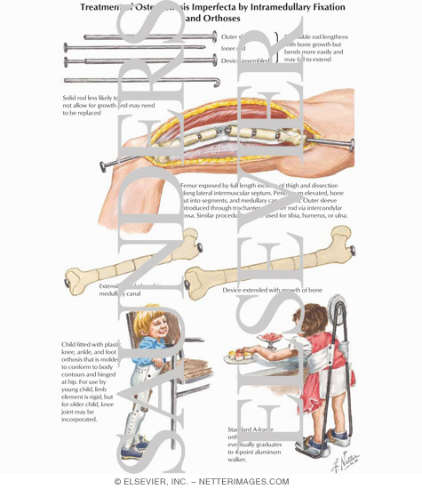 Treatment of Osteogenesis Imperfecta by Intramedullary Fixation and Orthoses