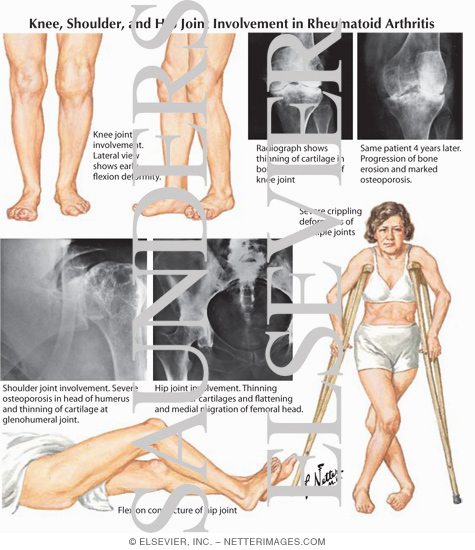 Knee, Shoulder, and Hip Joint Involvement in Rheumatoid Arthritis