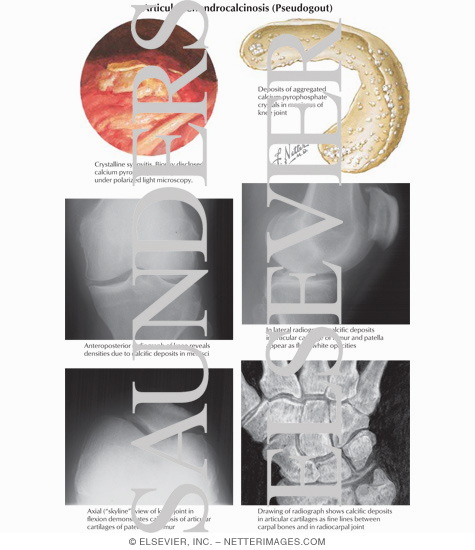 Watermarked preview of labeled image: Articular Chondrocalcinosis (Pseudogout)